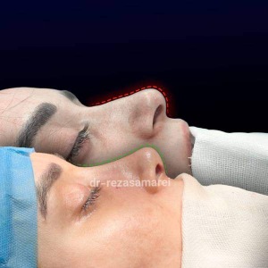 rhinoplasty-59