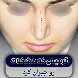 rhinoplasty-60