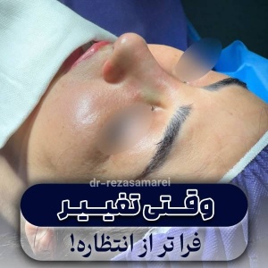 rhinoplasty-61