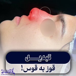 rhinoplasty-62