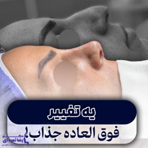 rhinoplasty-63