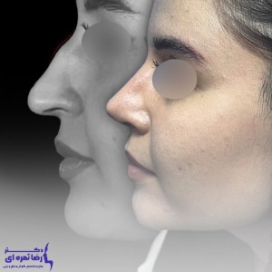 rhinoplasty-64