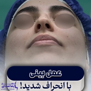 rhinoplasty-65