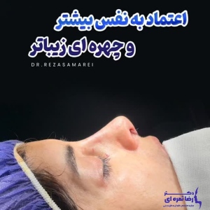 rhinoplasty-66
