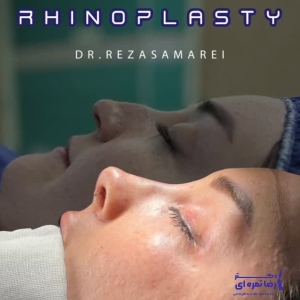 rhinoplasty-67