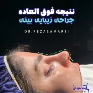 rhinoplasty-68