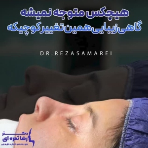 rhinoplasty-69