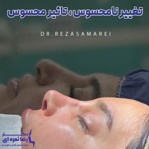 rhinoplasty-70
