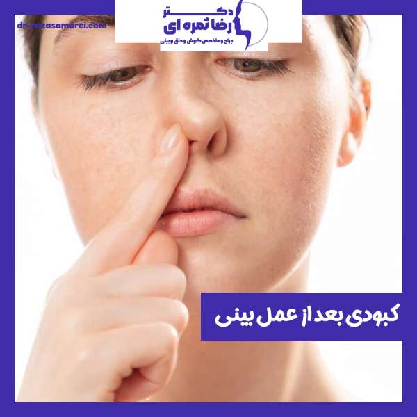 کبودی بعد از عمل بینی- دکتر رضا ثمره ای - dr-rezasamarei.com