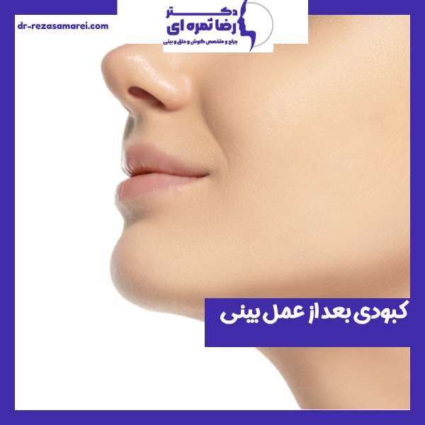 کبودی بعد از عمل بینی