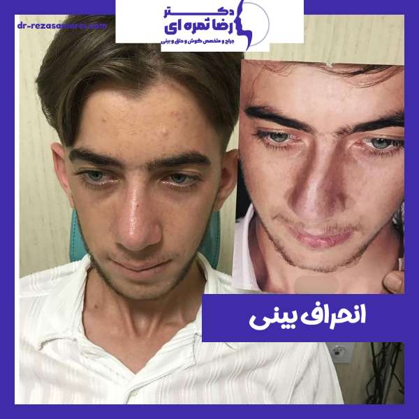 انحراف بینی - دکتر رضا ثمره ای