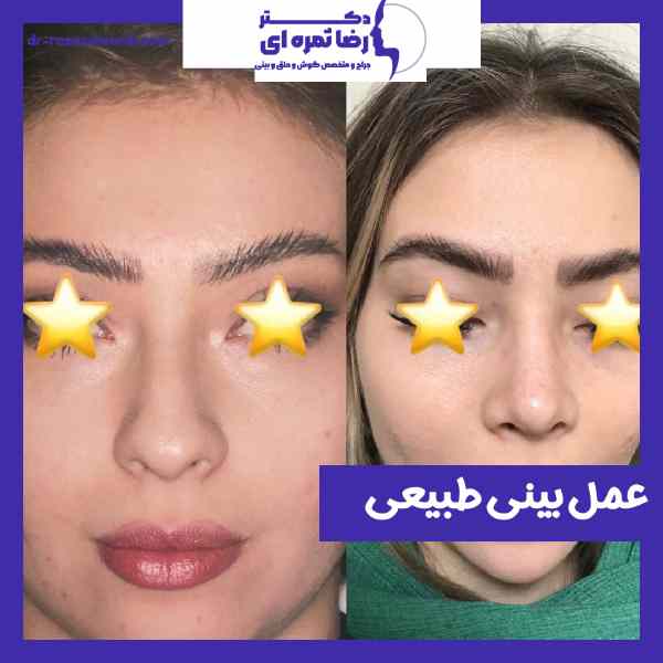 عمل بینی طبیعی در ارومیه- دکتر رضا ثمره ای - dr-rezasamarei.com