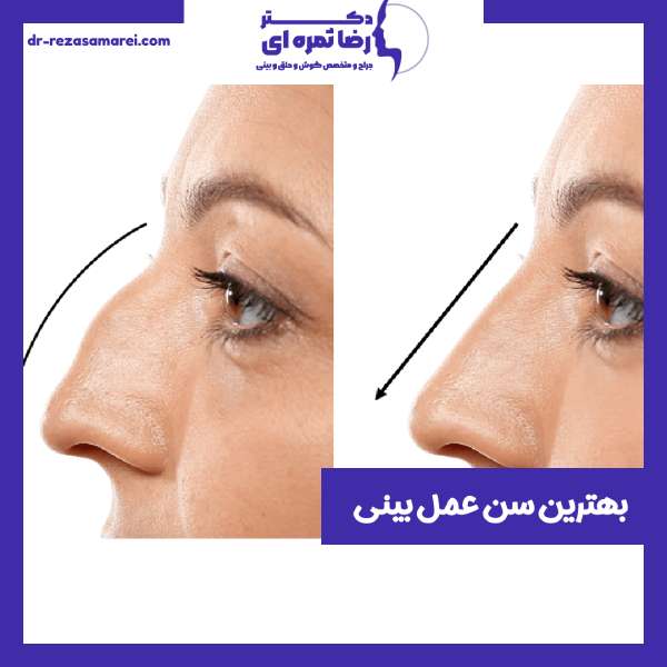 بهترین سن جراحی بینی
