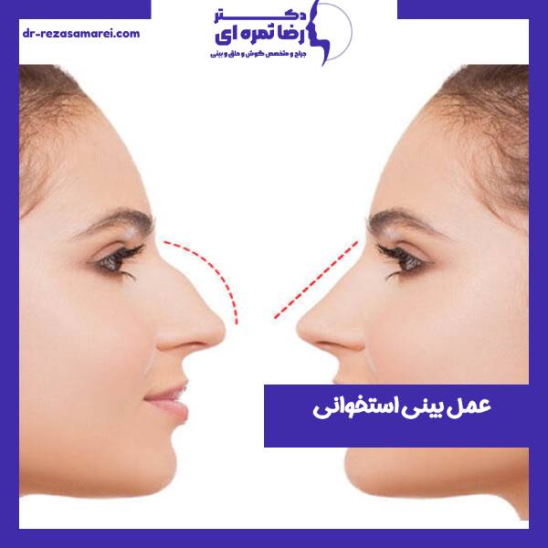 عمل بینی استخوانی