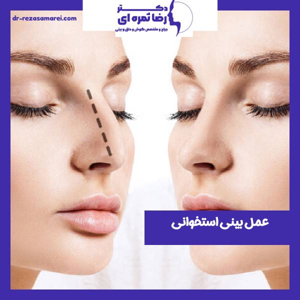 عمل بینی استخوانی - دکتر رضا ثمره ای - dr-rezasamarei.com