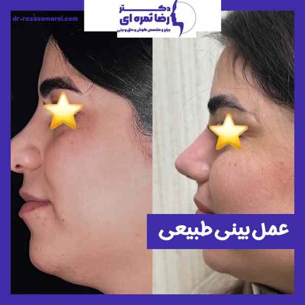 عمل بینی طبیعی
