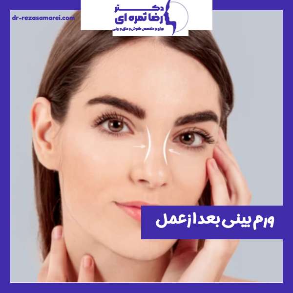 ورم بعد از عمل بینی