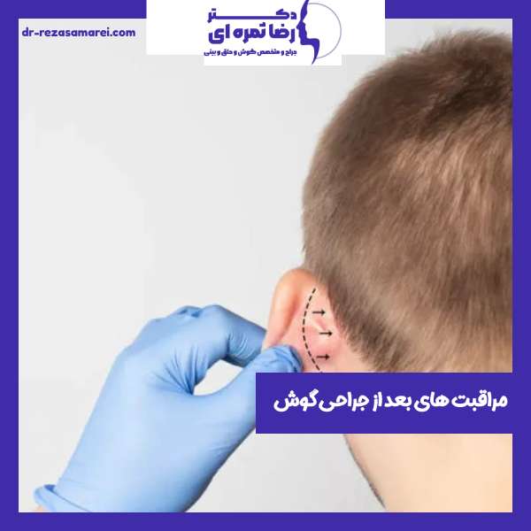 مراقبت های بعد از جراحی گوش یا اتوپلاستی