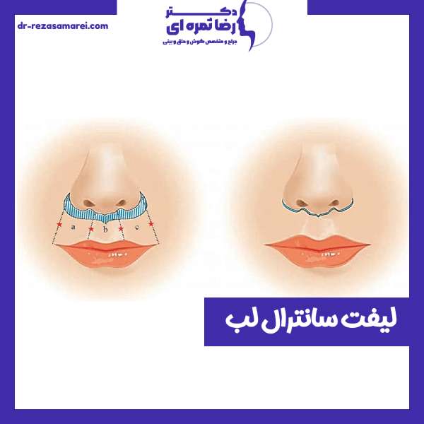 جراحی لیفت و سانترال لب