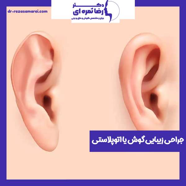 جراحی زیبایی گوش یا اتوپلاستی