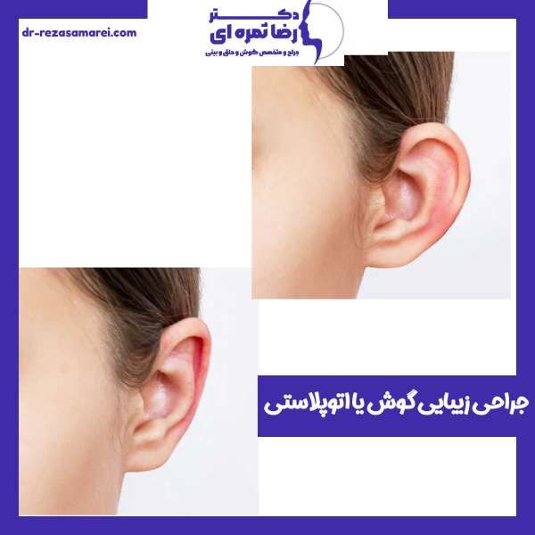 جراحی زیبایی گوش یا اتوپلاستی