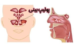 پولیپ بینی - دکتر رضا ثمره ای