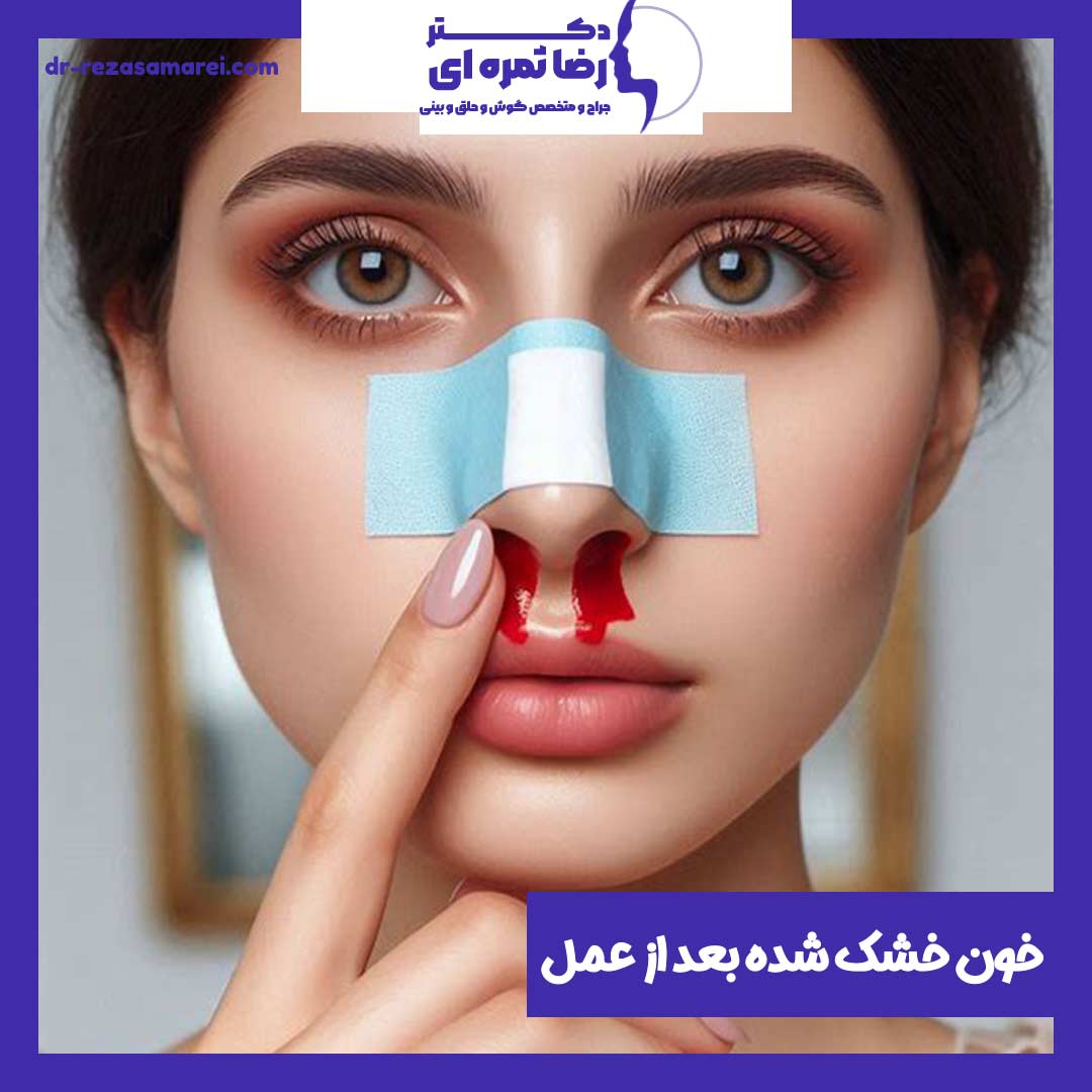 خون خشک شده بعد از عمل بینی - دکتر رضا ثمره ای