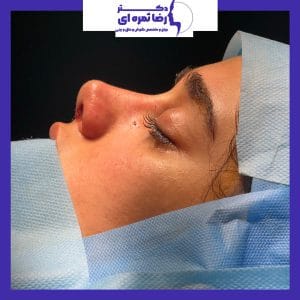 عکس جراحی بینی استخوانی - دکتر رضا ثمره ای - dr-rezasamarei.com