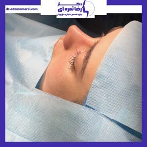 جراحی بینی استخوانی - دکتر رضا ثمره ای - dr-rezasamarei.com