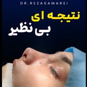 عکس عمل بینی استخوانی - دکتر رضا ثمره ای - dr-rezasamarei.com