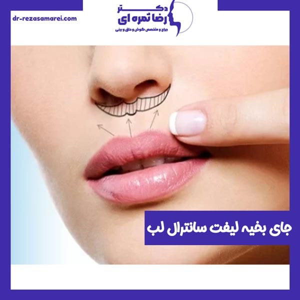 جای بخیه لیفت سانترال لب