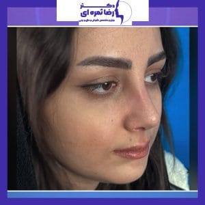 عکس نمونه کار بهترین جراح بینی ارومیه 2- دکتر ثمره ای - dr-rezasamarei.com