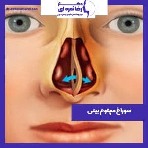 سوراخ سپتوم بینی - دکتر رضا ثمره ای -dr-rezasamarei.com