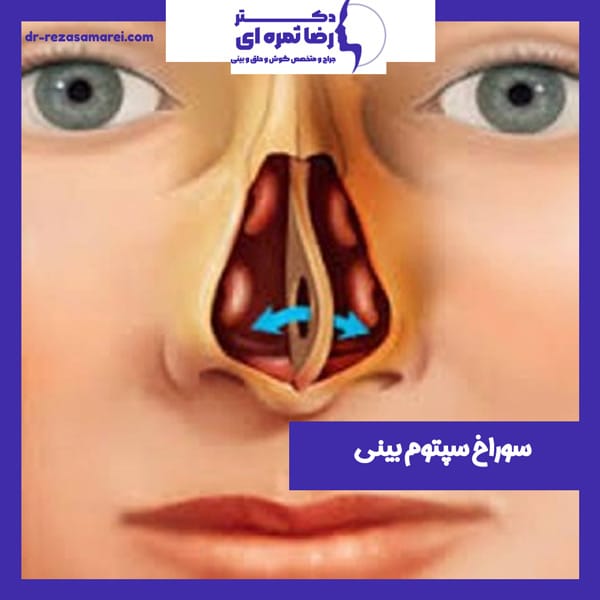 سوراخ سپتوم بینی - دکتر رضا ثمره ای -dr-rezasamarei.com